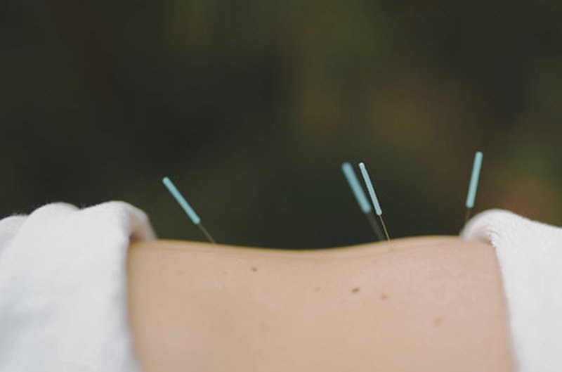 Close-up of acupuncture needles gently inserted into a patient's hand for pain relief and healing.