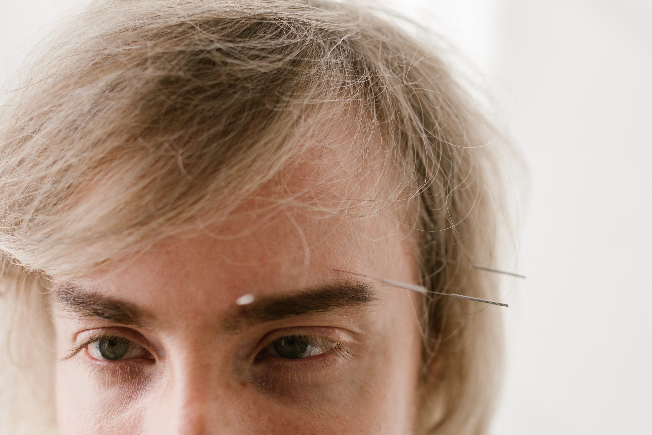 Facial acupuncture treatment for stress relief, relaxation, and holistic wellness.