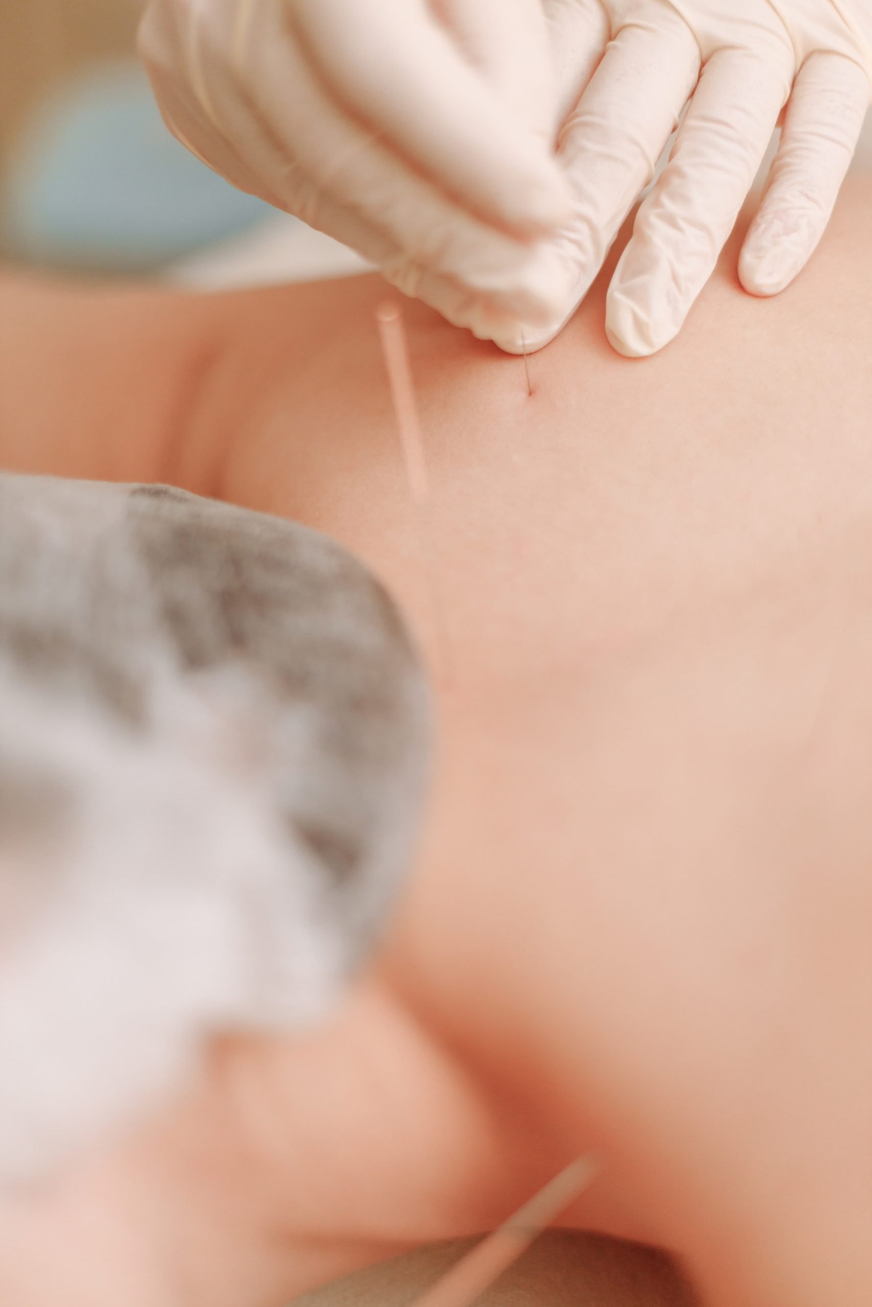Acupuncture treatment being performed on a patient's back and shoulders to relieve muscle tension.